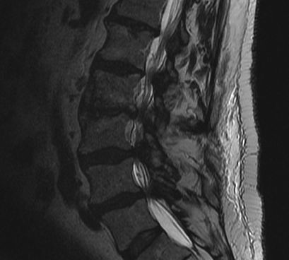 Lumbar Stenosis